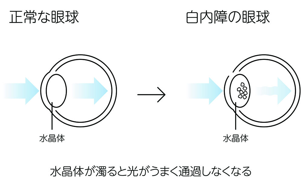 白内障
